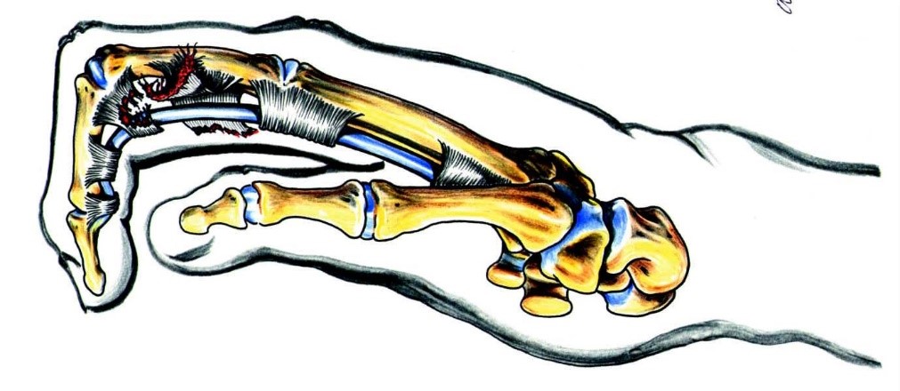 Illustrated drawing of a hand where you can see the finger and the thumb