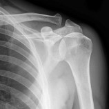 AC Joint, Acromioclavicular Joint